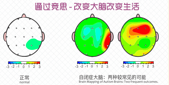 阿斯伯格综合征与自闭症孤独症大脑效果图