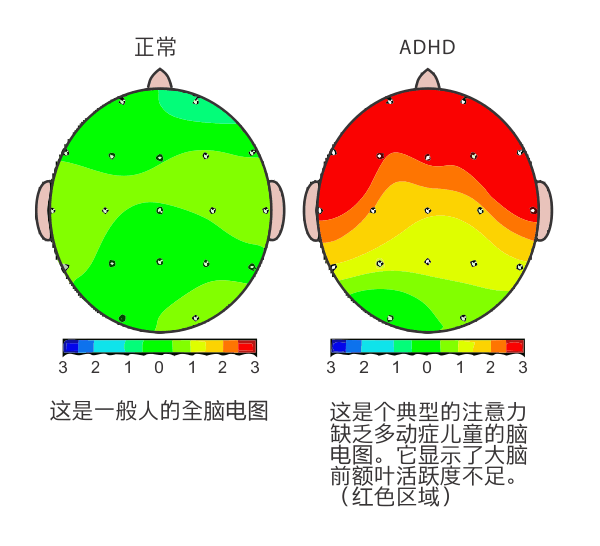 正常儿童大脑与儿童多动症大脑